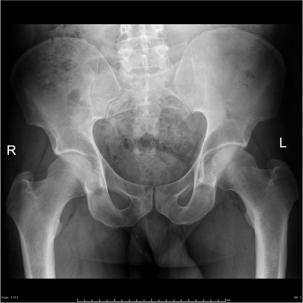No abnormality detected! Right hip pain.