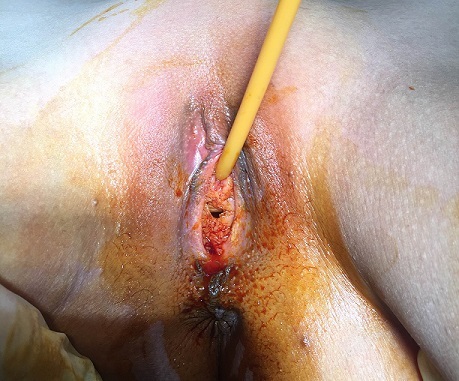 File:AIS - Clinical aspect of the vagina.jpg