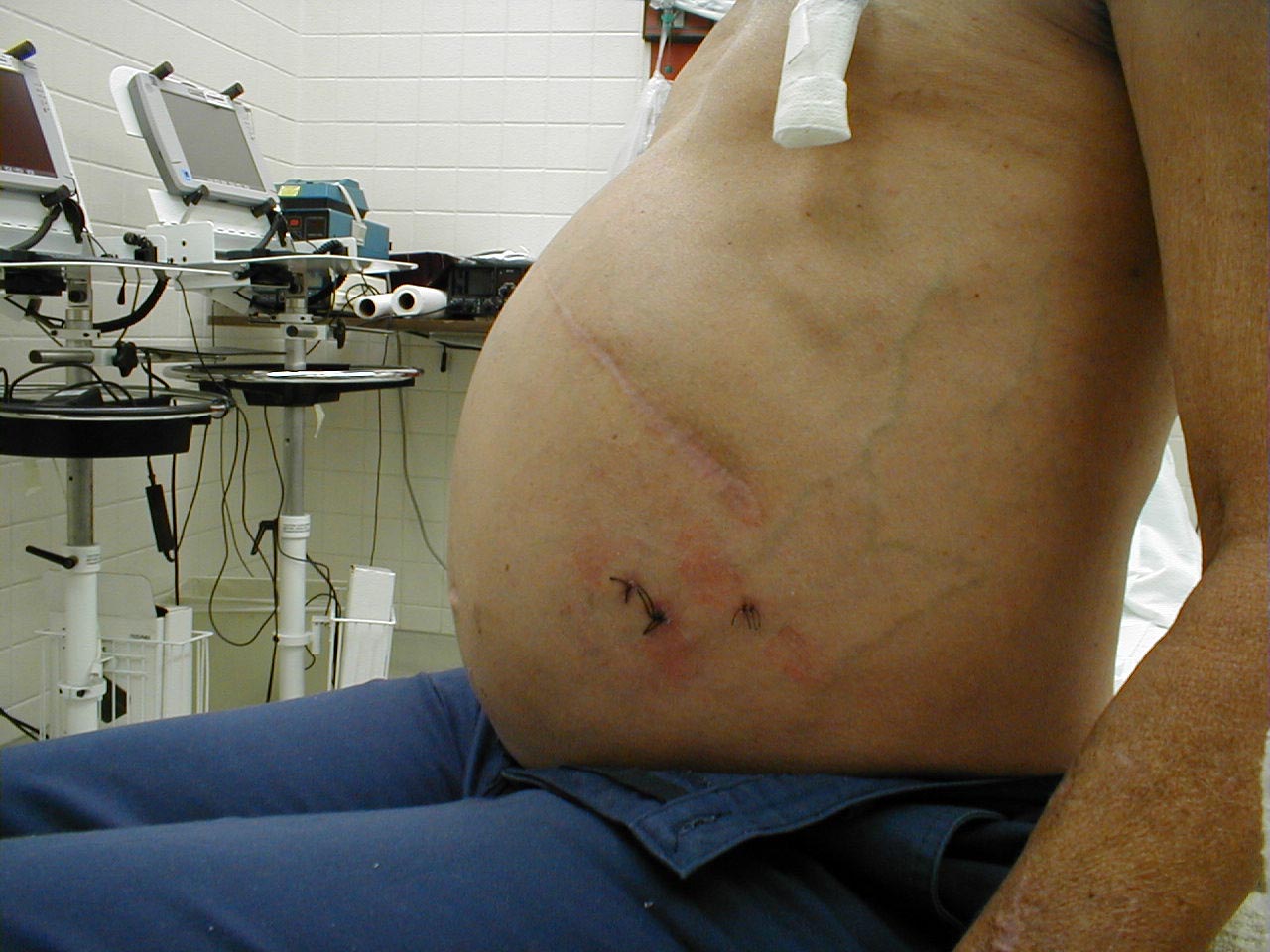 Ascites: Lateral view of abdomen tensely distended due to ascites.