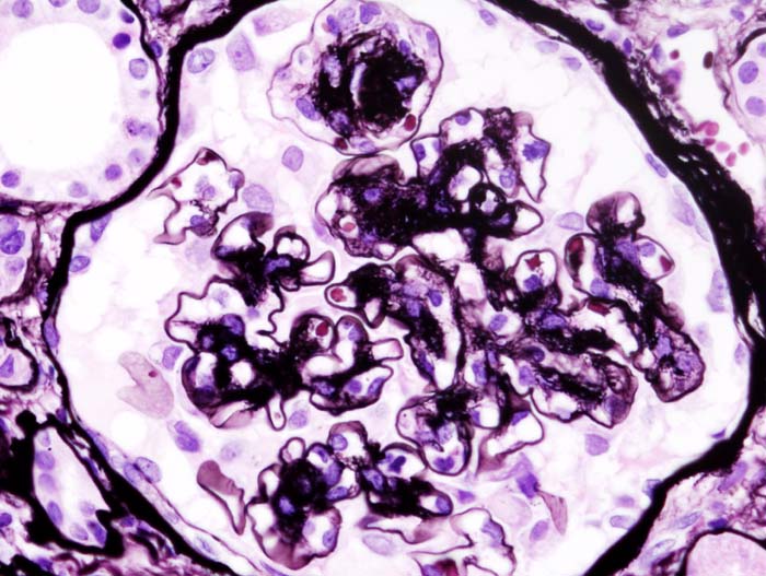 Histopathological image of diabetic glomerulosclerosis with nephrotic syndrome. PAM stain.