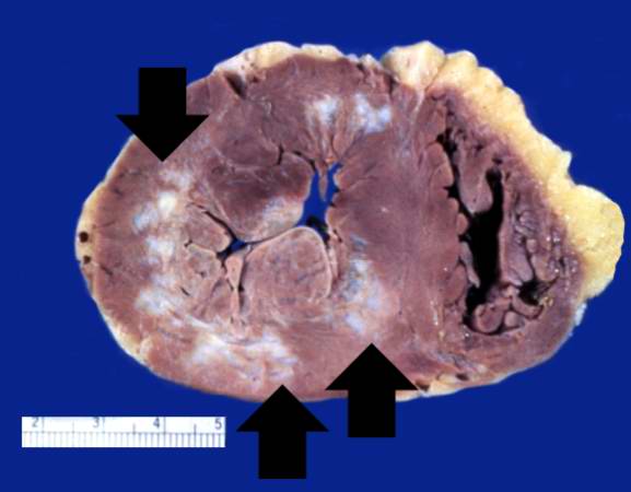 This is a gross photograph of a heart with areas of old healed myocardial infarction (scars) outlined by arrows.
