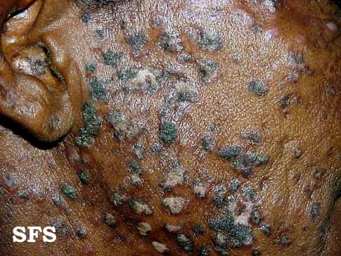 Lupus erythematosus chronicus disseminatus superficialis. Adapted from Dermatology Atlas.[1]