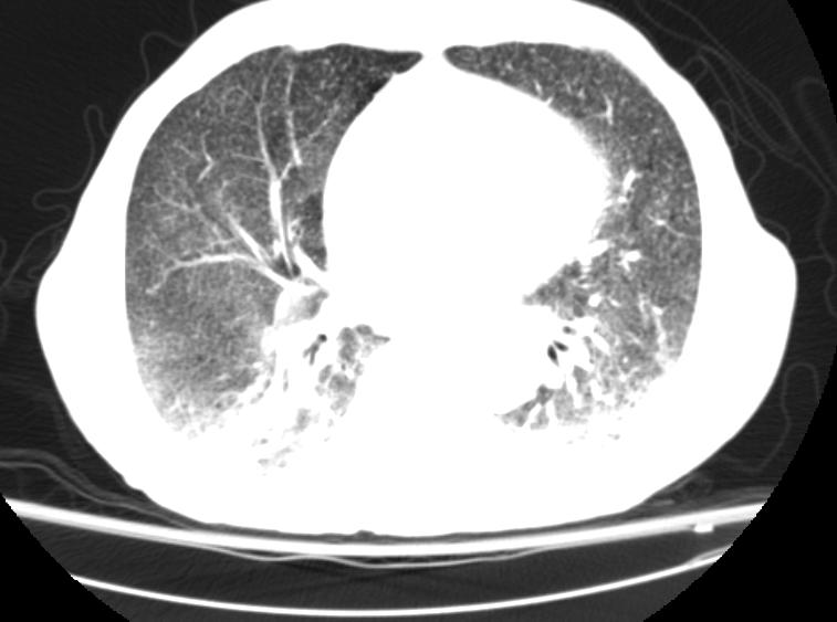 File:Miliary tuberculosis CT 103.jpg