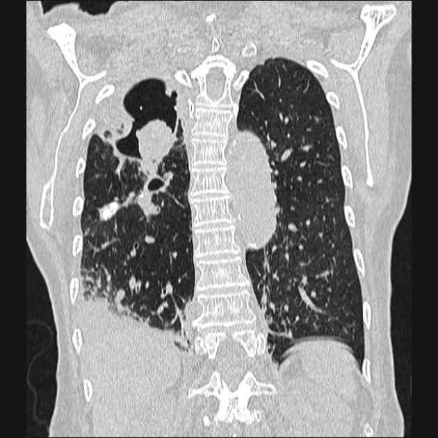 Chest CT (coronal lung window view) demonstrates an extensive cavitation in the right lung apex, within which there is a rounded mass soft tissue