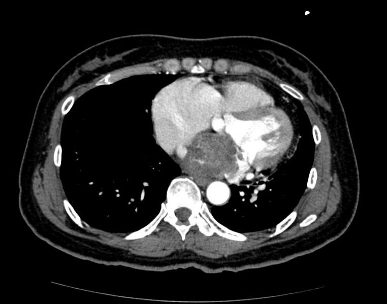 Cardiac Rhabdomyosarcoma Image courtesy of RadsWiki and copylefted