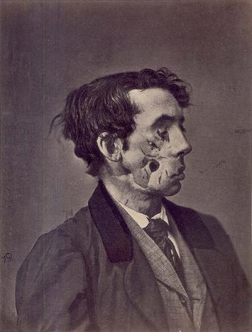 File:Civil War facial wound.jpg