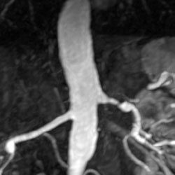 File:Renal artery stenosis 015.jpg