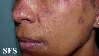 Subacute cutaneous lupus erythematosus. Adapted from Dermatology Atlas.[9]