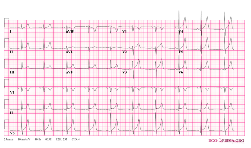 ECG in acute pericarditis showing diffuse ST elevation