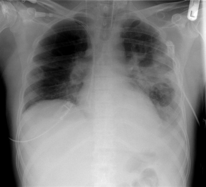 File:659px-XR chest - pneumonia with abscess and caverns - d0.jpg