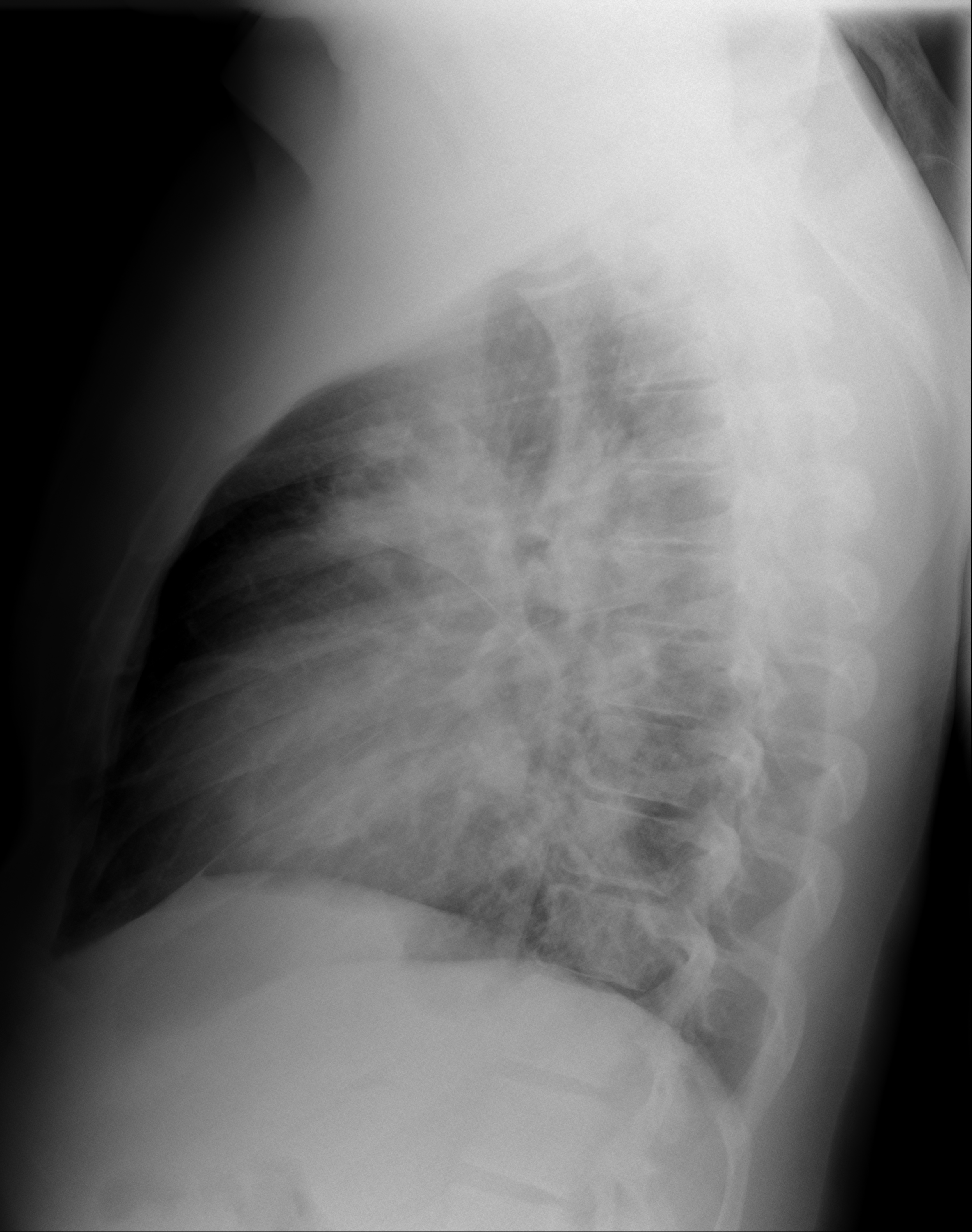 File:Bronchopneumonia (lateral).png