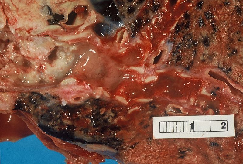Photograph of a squamous cell carcinoma. Tumor is on the left, obstructing the bronchus with inflammation and mucus accumulation in the bronchus.