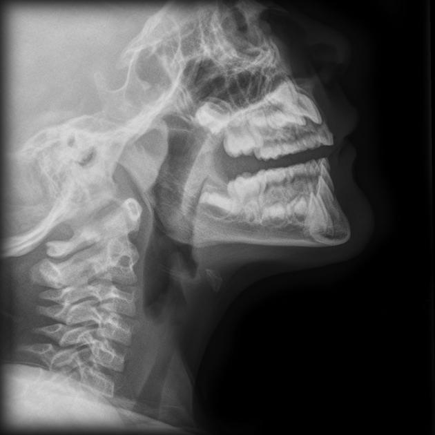Lateral view of the steeple sign in a croup patient that also displays distended hypopharynx. From Radiopaedia Image Library. [2]