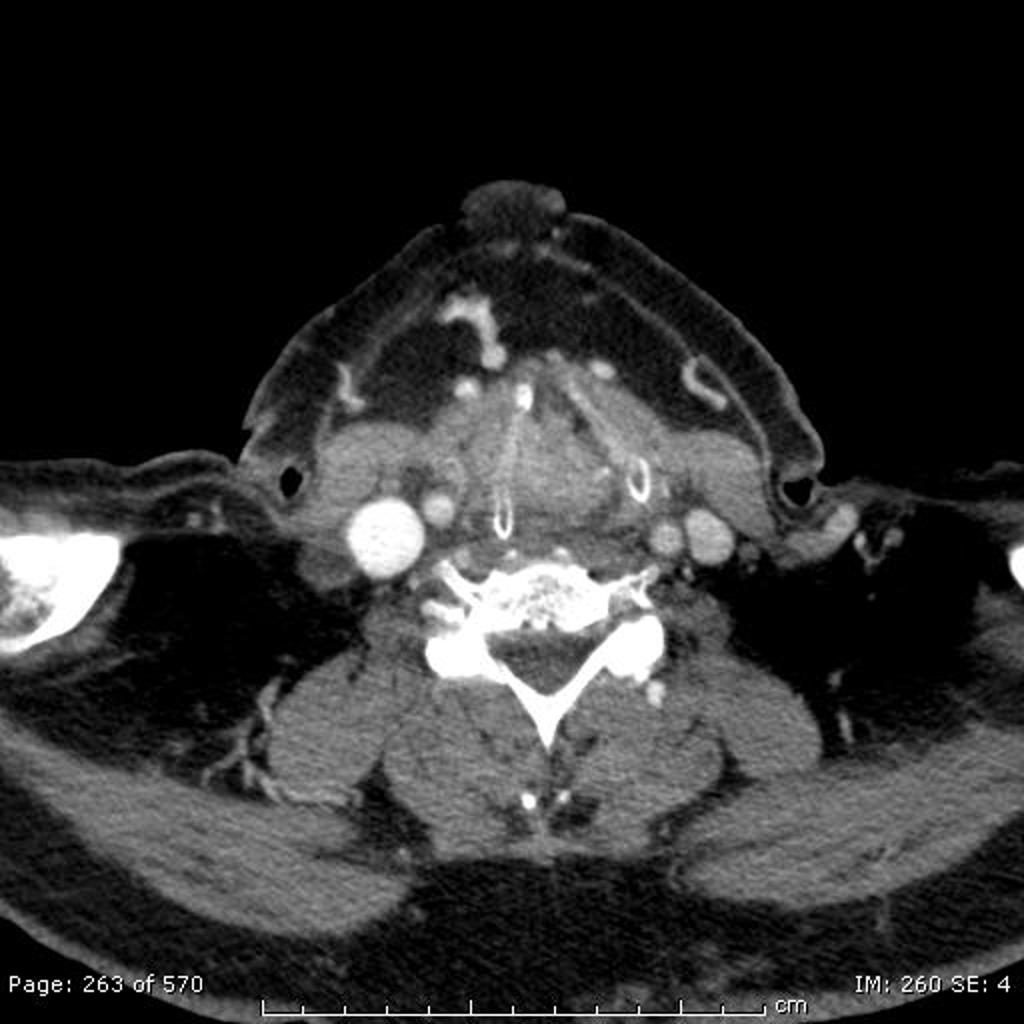 CT scan Laryngeal carcinoma[1]