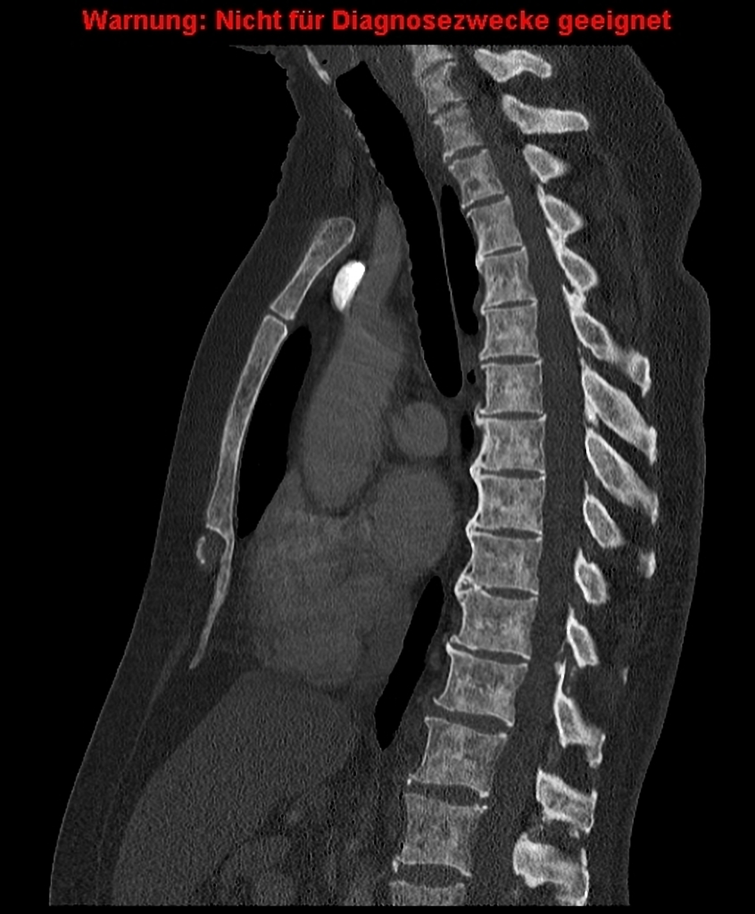 CT in the bone window demonstrates marked heterogenous sclerosis of the complete thoracic skeleton, especially pronounced in the spine.[2]
