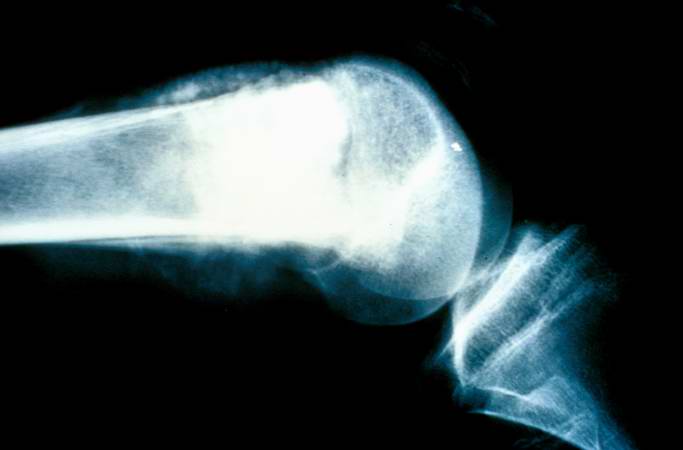This is a radiograph showing the tumor in the distal femur.