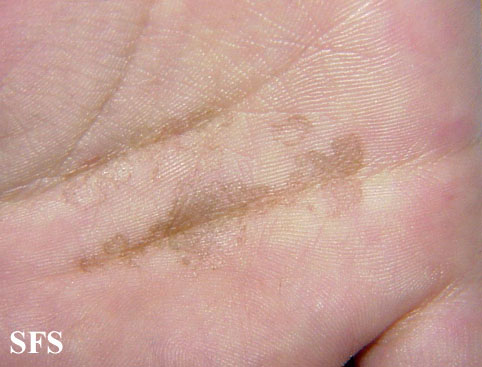 Tinea nigra. Adapted from Dermatology Atlas.[6]