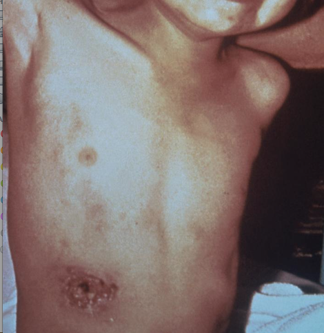 Ulcerated skin lesion at a plague inoculation site caused by the Gram-negative bacterium, Yersinia pestis. From Public Health Image Library (PHIL). [13]