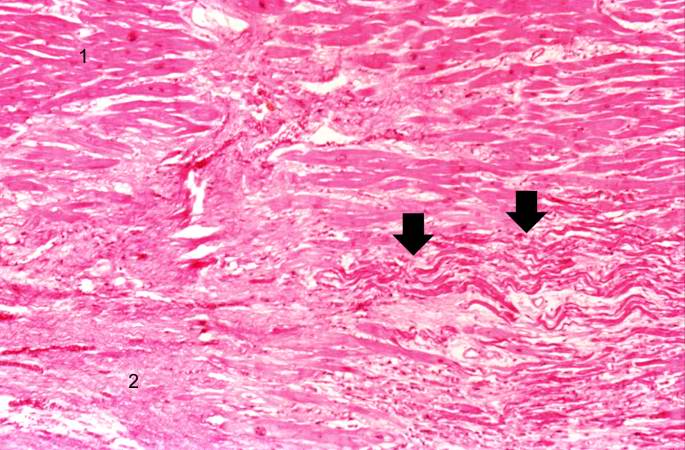 This is a higher-power photomicrograph of a healed myocardial infarction with a fibrous scar. Remaining normal tissue is at the top (1) and the fibrous connective tissue scar is at the bottom (2). Note the presence of occasional hypereosinophilic myocytes indicating recent acute ischemic injury to this region of old scar tissue (arrows).