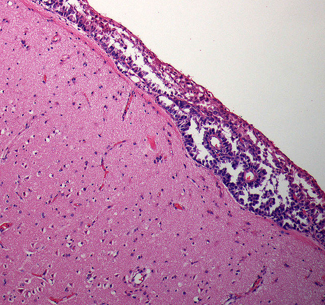File:Hirnbiopsie menigiosis.jpg
