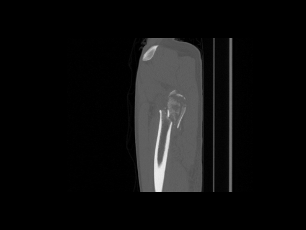 Sagittal non-contrast. Comminuted intertrochanteric fracture involving the left proximal femur with internal rotation the femur following a road traffic accident.