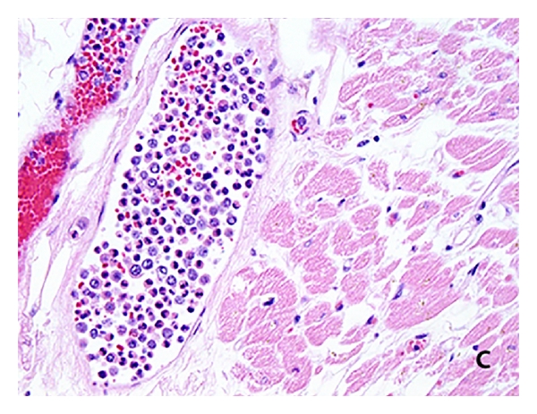 Retrospective evaluation of the bone marrow also showed inconspicuous large cells in clusters.[1]