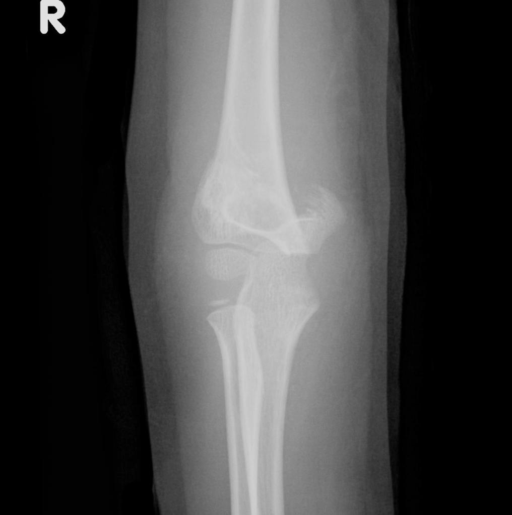 There is an obvious supracondylar fracture with posterior displacement of the distal fracture fragment and no communication between the cotices.
