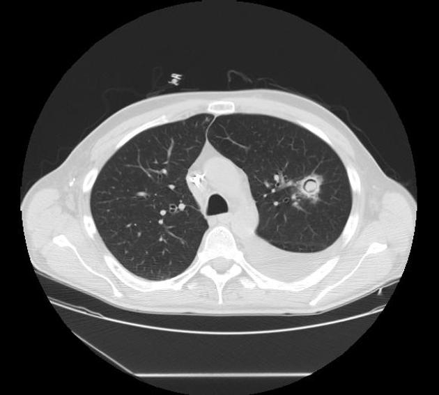 File:CT scan Aspergillosis.jpg