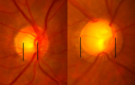 0.5 to 0.9 cup-to-disc ratio. Increase seen with open angle glaucoma.