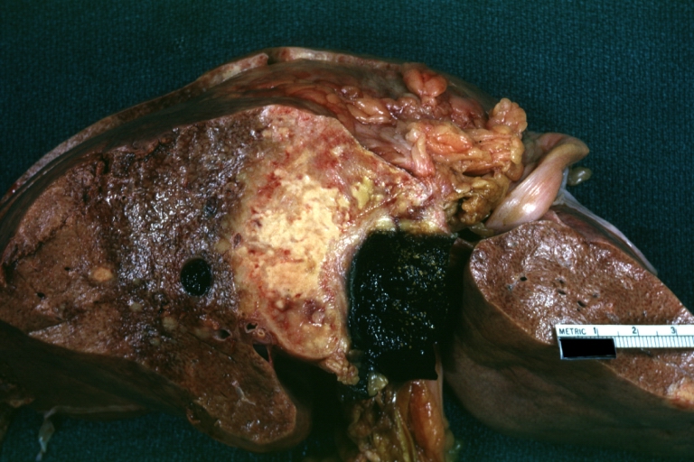 Gallbladder carcinoma: Gross, natural color slab of liver with gallbladder