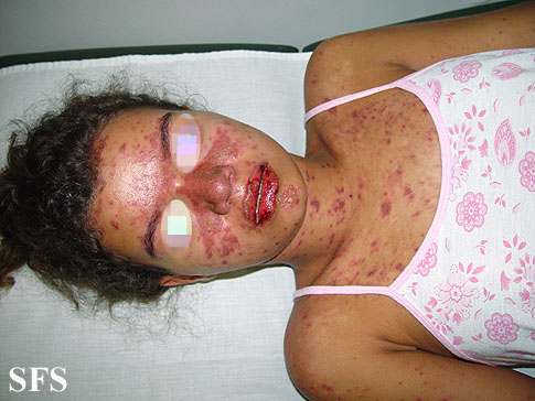 Lupus erythematosus-systemic. Adapted from Dermatology Atlas.[29]