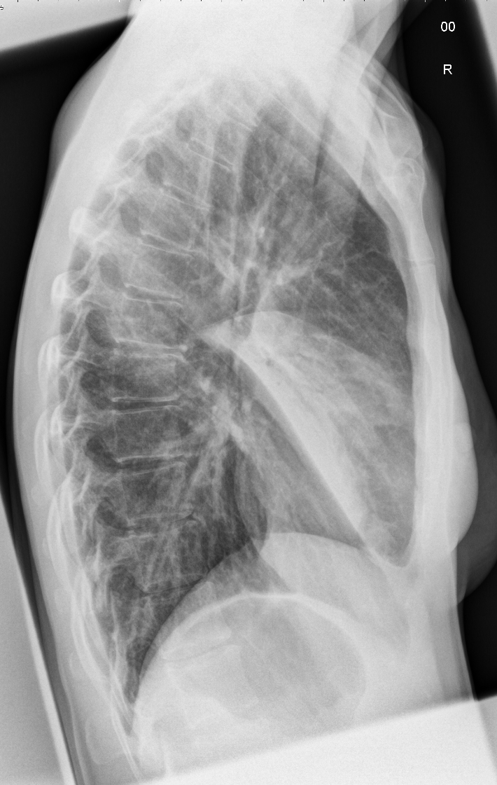File:Middle-lobe-pneumonia-lateral.jpg