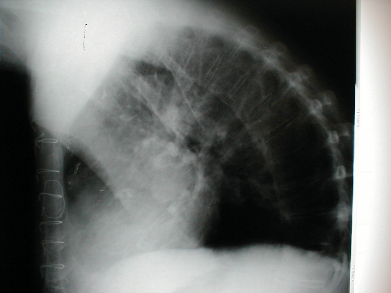 Accompanying X-Ray of same patient clearly demonstrates extreme curvature of the spine.