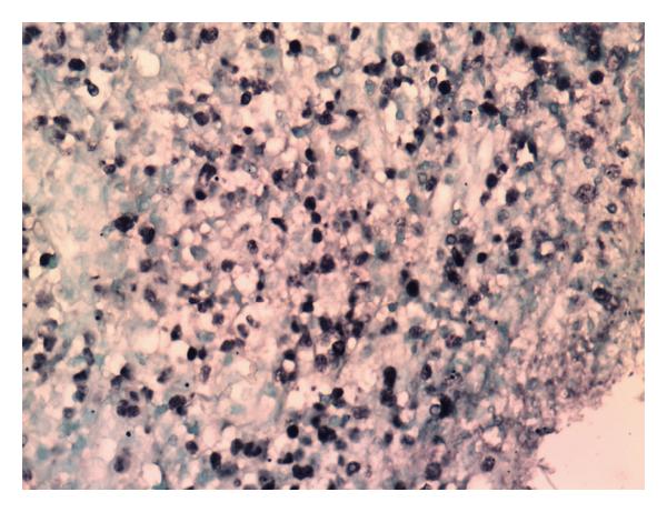 File:Extranodal Nk-T cell lymphoma image 2.jpg