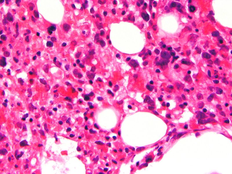 Haemophagocytic lymphohistiocytosis Bone marrow.JPG