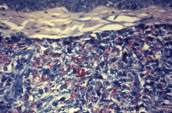 Acid-fast-stained photomicrograph of tissue sample from a patient with leprosy, revealing chronic inflammatory lesion (granuloma) within which numerous red-colored Mycobacterium leprae bacteria are visible. Adapted from Public Health Image Library (PHIL), Centers for Disease Control and Prevention.[19]