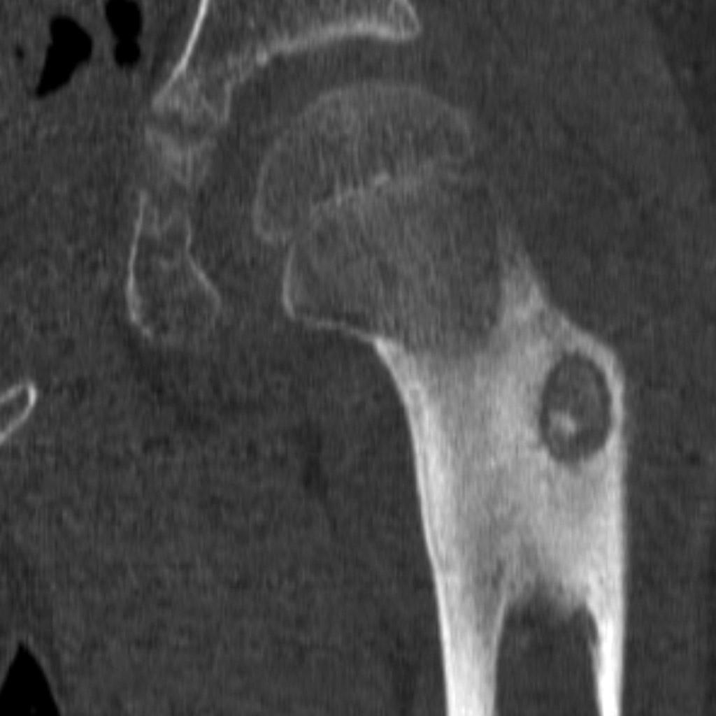 File:Osteoid-osteoma-1.jpg