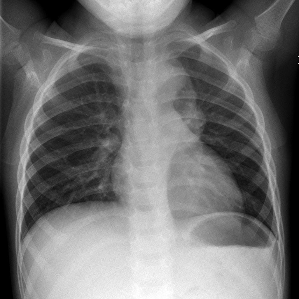 Neuroblastoma observed on chest X ray as a large left sided paraspinal mass.[1]