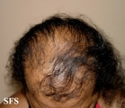 File:Androgenetic alopecia 01.jpg