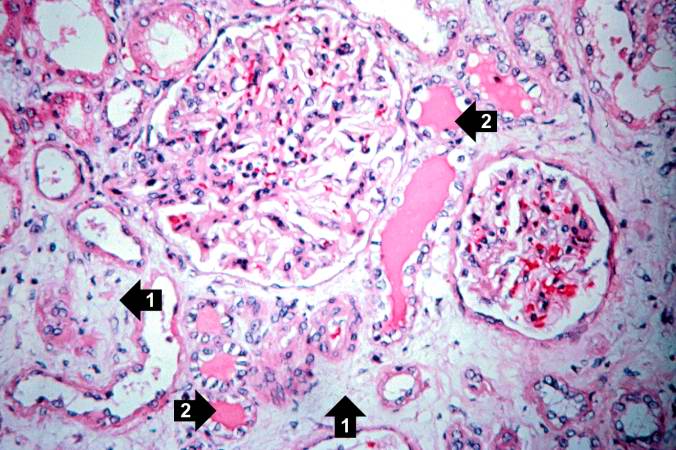 This is a photomicrograph of a glomerulus with a mild cellular infiltrate (left) and a small damaged glomerulus (right). There is extensive interstitial fibrosis (1), loss of renal tubules, and the remaining tubules contain protein (2) indicating severe damage.