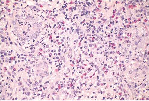 Drug-induced interstitial nephritis, with prominent eosinophilic.png