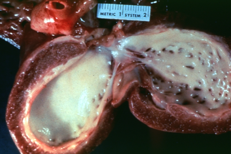 Endocardial fibroelastosis: Gross, an excellent example, infarct heart