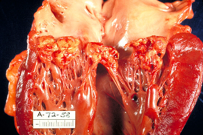 Gross pathology of subacute bacterial endocarditis involving mitral valve. From Public Health Image Library (PHIL). [9]