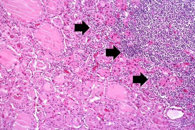 This is a high-power photomicrograph showing the inflammatory cells infiltrating into the residual thyroid tissue (arrows).