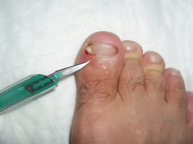 Paronychia: Infection of the skin medial and inferior to nail of great toe. Post I&D. (Courtesy of Charlie Goldberg, M.D.)