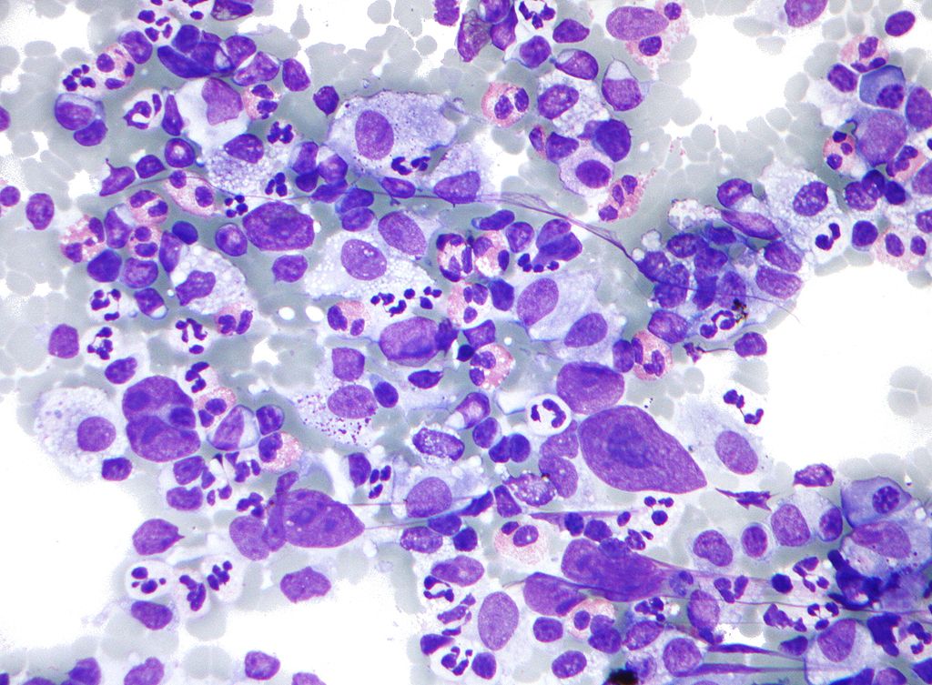 File:Hodgkin lymphoma cytology large.jpg
