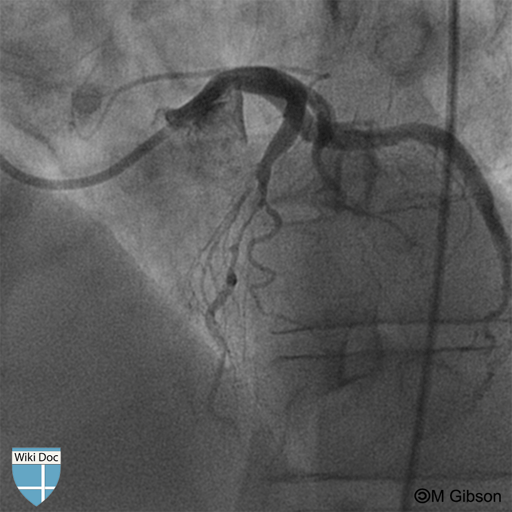 Shape of the coronary artery during diastole