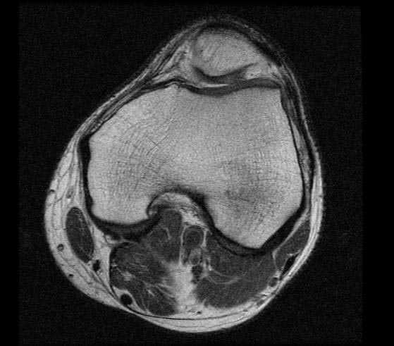 MRI: Normal knee