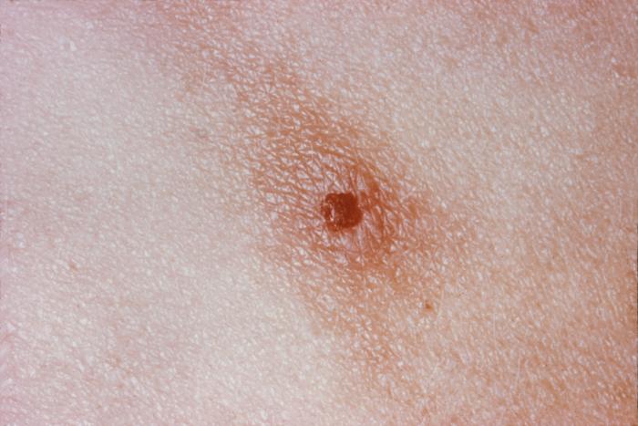 This is a skin lesion in a patient with systemically disseminated Neisseria gonorrhoeae bacteria.Gonorrhea, caused by Neisseria gonorrhoeae, if left untreated will enter the blood, thereby, spreading throughout the body. As is shown here, such fully systemic dissemination may manifest itself as skin lesions throughout the body.Adapted from CDC