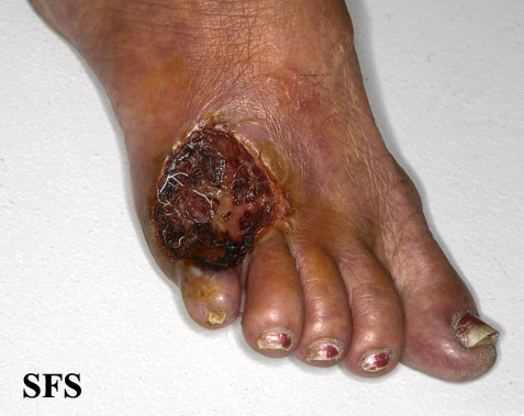 Peripheral occlusive arterial disease. Adapted from Dermatology Atlas.[1]